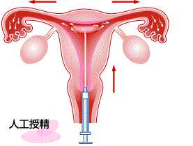 怀孕香港验血会出错吗,人工受孕包括人工授精和试管婴儿，两者的不同只在前